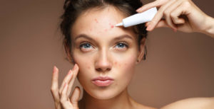 Benzoyl Peroxide for Clearing up Acne