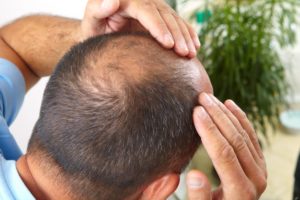 Home Common Hair Transplant problems