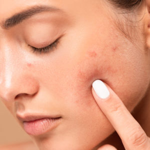 Organic Acne Treatments